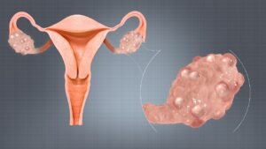 Polycystic ovary syndrome